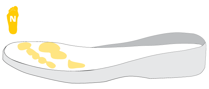 Neuropathic foot